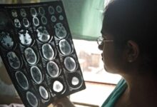 Photo of WHO calls for greater investment in brain health and care services